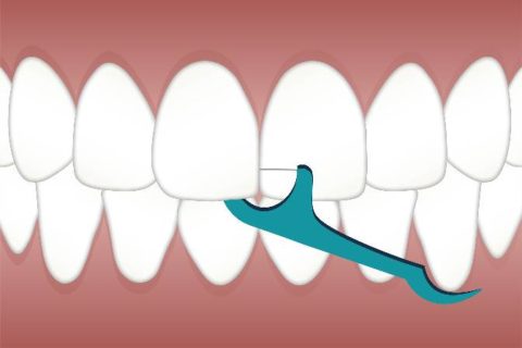 歯石除去と嚥下障害