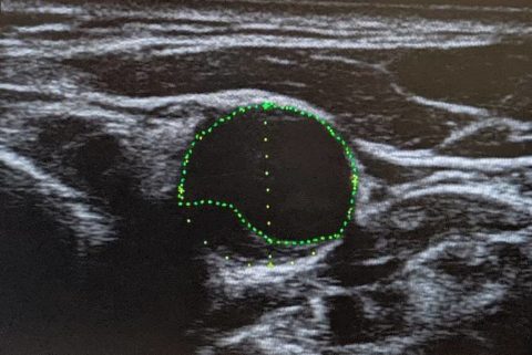 脂質異常症治療への決断