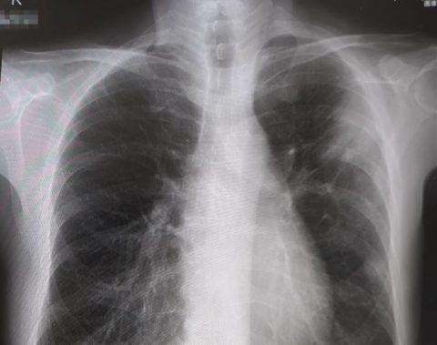 ワレンベルグ症候群と肺炎