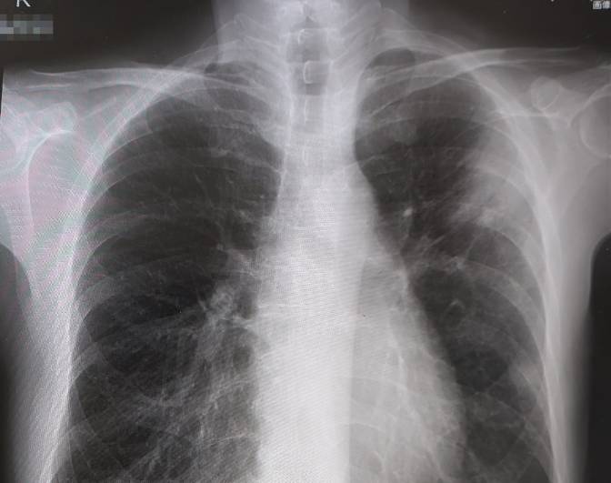 肺炎のレントゲン写真、左上部にうっすらと白い影